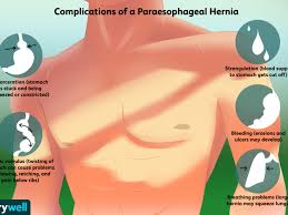 During a duodenal intubation the probe does not pass from the stomach into the duodendum. Paraesophageal Hiatal Hernia Complications