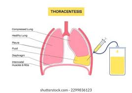 Image result for Thoracentesis