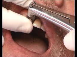 Maybe you would like to learn more about one of these? Richmond Crown Removal With Wam X Descellement D Une Couronne Richmond Avec Wamx Youtube