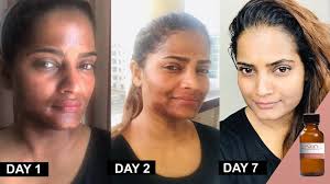 What to expect before, during and after a chemical peel. 25 Tca Chemical Peel At Home Method And Progress By Hina Urdu Hindi Youtube