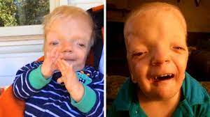 6 Year Old Boy S Disease So Rare Doctors Named It After Him Youtube