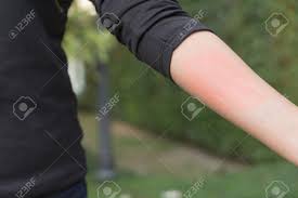 What are the common signs of a food allergy? Closed Up Of Woman Arm With Red Sensitive Skin Food Allergy Symptoms Irritation Stock Photo Picture And Royalty Free Image Image 95370130