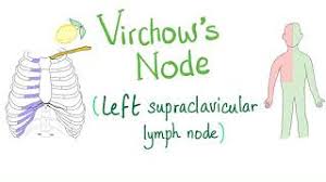 By and large, children have weak immune systems and are prone to infections. Virchow S Node Left Supraclavicular Lymph Node Youtube