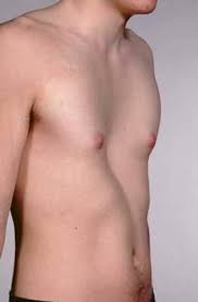 Image result for Pectus Excavatum