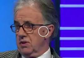 Mark Lawrenson meets Liverpool fan who spotted his cancerous lesion