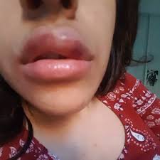 How to reduce swelling after lip injections at the first appointment, patients should start conservatively and build from there to achieve their desired results. Is This Much Bruising Swelling Normal After Lip Fillers Photos