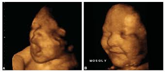 Acesta consta in celule si lichid amniotic inchitite odata cu. Etapele Dezvoltarii Fatului Pe Saptamani