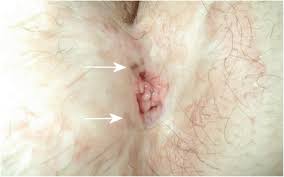 Use the menu to see other pages.staging is a way of describing where the cancer is located, if or where it has spread, and whethe. The Treatment Of Perianal Skin Horseshoe Melanoma By Advancement Flap Y V Shaped And The Assessment Of Outcome Over A Long Term Follow Up Springerlink