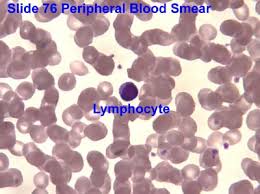 Image result for Peripheral Smear