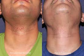 Time & money with our laser hair removal treatments! Laser Hair Removal Medical Spa San Diego Ca Clderm