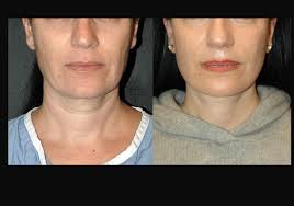 Andrew Jacono, MD, FACS