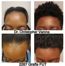 Hair Restoration Before After Newport Beach Fue Pictures Dr Varona Hair Restoration Hair Transplant Fue Hair Transplant Before After