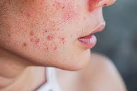 Image result for Dry Skin