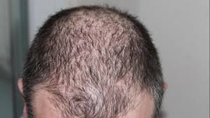 Hair loss related to chemotherapy. Breakthrough Invention Prevent Hair Loss Due To Chemotherapy