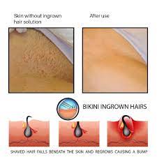 100ml Pansly Ingrown Hair Serum Smoothing Skin Reduce Dark Spots Redness Razor Burns Solution After Shave Razor Bump Stopper Hair Removal Cream Aliexpress
