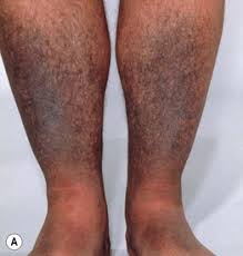 Image result for Pigment stains on the shin