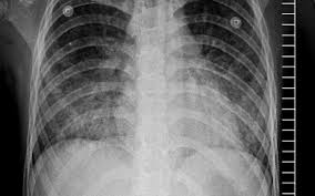 Acute respiratory distress syndrome (ards) is noncardiogenic pulmonary edema that manifests as rapidly progressive dyspnea, tachypnea, and hypoxemia. Covid 19 Ards Clinical Features And Differences To Usual Pre Covid Ards The Medical Journal Of Australia