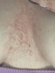 Image result for Candidiasis under breasts