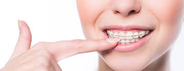 How long does it take to get braces off? Can I Have My Braces Off Earlier Than Expected Weber Orthodontics