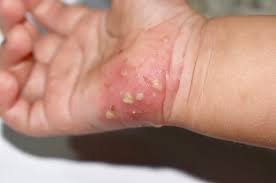 Image result for scabies in the groin area