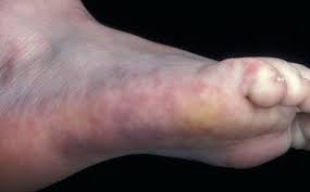 It's an autoimmune disease, which means that your immune system — the body system that usually. Lupus Erythematodes Springerlink