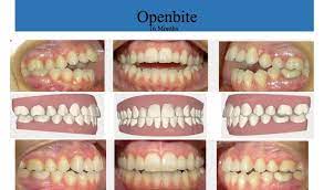 And that all depends on how long your treatment is gunna take dependeing on how bad of shape your teeth were in before getting braces. How Do Braces Affect Your Face