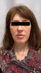 I had cosmetic surgery at a clinic in Turkey called Rememore — 8 in 1  operation! Dr. Can İlker Demir : r/cosmeticsurgery