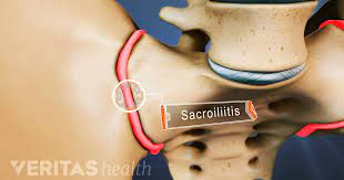 Symptoms of si joint syndrome are often difficult to distinguish from other types of low back pain. Sacroiliac Joint Dysfunction Symptoms And Causes