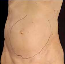 Image result for Splenomegaly