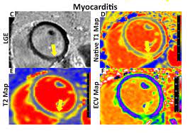 After learning she had myocarditis, an inflammation of the heart that has been linked to some covid cases, vanderbilt basketball player demi washington spent months hoping she could play again. Covid 19 Related Myocarditis In Athletes Vanderbilt Discover