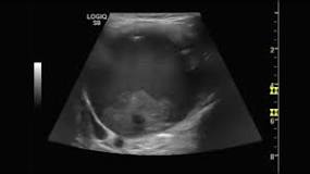 SUPRAPUBİK PELVİK US ile ilgili görsel sonucu