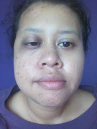 Bila dah ada ketumbuhan dalam hidung, hingus blok tak boleh keluar. Menderita Kanser Hidung Selepas Berpantang Wanita Ini Share Bagaimana Dia Sembuh Walaupun Buta Nona