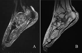 This is a 30 year old with swelling on the lateral aspect of foot with evidence of soft tissue lesion in relation to the lateral aspect of the talus which appears isointense to the muscles on t1 and t2. Epos Trade