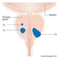 Please understand that our pho. Tnm Staging System Results And Prostate Cancer Treatment