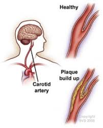 Common carotid arterythe right common carotid artery is a branch of the brachiocephalic artery.it begins in the neck behind the right sternoclavicular joint. What Is Carotid Artery Disease Causes Of Stroke Stroke Prevention