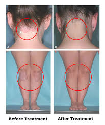 Https Www Ebay Com Itm 1x Pl L 36w 01 Uvb 311nm Lamp Vitiligo Psoriasis Vitamin D Tester Med 153871508125