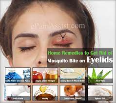 Mosquito bite on eyelid baby. Home Remedies To Get Rid Of Mosquito Bite On Eyelid