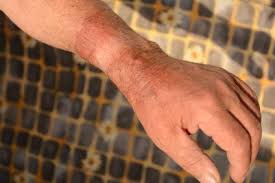 Verbrannt Beim Grillen Was Tun Gasgrill Net