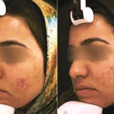 After suffering with painful cystic hormonal acne for a year i decided to go to body brite medical spa for. Pdf Evaluation Of Efficacy Of Intense Pulsed Light Ipl System In The Treatment Of Facial Acne Vulgaris Comparison Of Different Pulse Durations A Pilot Study