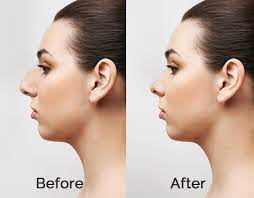 Nose surgery in jaipur is available at many clinics and that too by trained surgeons. Plastic Surgery Cost In South Korea Top Clinics And Best Plastic Surgeons