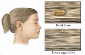 Nov 01, 2012 · the contents of the tube were applied to dry hair and the scalp, left on for 10 minutes, then rinsed off with water. Let S Get Nitpicky Prevention And Treatment Strategies For Head Lice Lewisgale Physicians