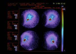 What Is A Hida Scan Uses Side Effects Procedure Results