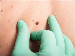 Typical symptoms are a painless swelling or lump in 1 of the testicles, or any change in shape or texture of the testicles. Skin Cancer Types Symptoms And Treatment In Chennai
