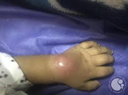 Image result for Dactylitis