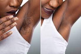 Laser hair removal can be done safely in people of color. Laser Hair Removal For All Skin Tones African American Skin Los Angeles