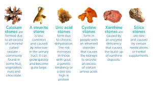 Kidney Stones