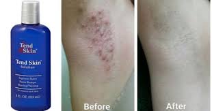 Before And After Black And White Bleaching Cream Reviews 15 Miracle Beauty Products With The Most Satisfying Before And After Photos Tend Skin Body Skin Care Beauty Care