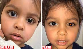 The exact cause of most eye cancers is not known. Retinoblastoma Symptoms How A Photo Taken With A Flash Could Show Your Child Has Cancer Daily Mail Online