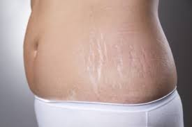 The main reason we get them is genetic. How Dermaroller Before And After Stretch Mark Treatment Works Rejuviss