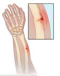 Buckle fracture symptoms a forearm buckle fracture usually results in severe pain. Greenstick Fractures Symptoms And Causes Mayo Clinic